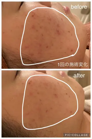 夏までに肌荒れ卒業 するサロン🌻のエステ・リラクイメージ