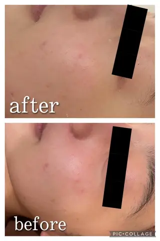 セミロング カラー パーマ ヘアアレンジ メンズ キッズ ネイル マツエク・マツパ アイブロウ ニキビ特化型エステ 🍓最短で肌質改善のエステ・リラクイメージ