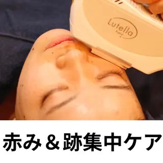 ニキビ・ニキビ跡改善 leoloのエステ・リラクイメージ