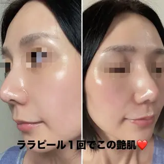 ハーブピーリング/韓国肌管理/フェイシャル/毛穴洗浄/眉毛/顔脱毛【糸脱毛専門】rev所属・ハーブピーリング🌹 毛穴洗浄❤️眉waxのエステ・リラクイメージ