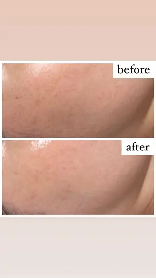 【ハーブピーリング】 Allumentのエステ・リラクイメージ