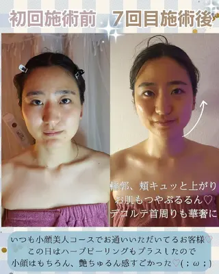 痩身ハーブピーリング 筋膜リリース☆B&Hのエステ・リラクイメージ