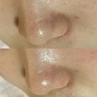 タルミ,ニキビケア専門PICHi BEAUTeピチボーテ所属・トクシゲ マホのエステ・リラクイメージ