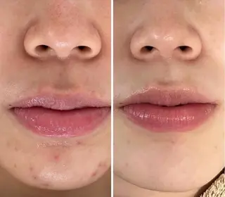 べアール所属・小顔/毛穴/ニキビ salon bealのその他イメージ