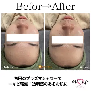 Meupニキビ専門店 背中/ハーブ/肌管理のその他イメージ