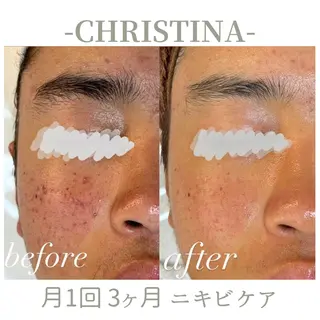 肌質改善|天王寺 For...はるかのエステ・リラクイメージ