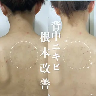 SALON    REVIE所属・🌿ニキビ・毛穴🤍 横浜ハーブピーリングのエステ・リラクイメージ