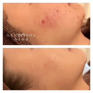 ロング パーマ ヘアアレンジ メンズ キッズ ネイル マツエク・マツパ アイブロウ ニキビ跡専門サロン Ａｉｎａのエステ・リラクイメージ