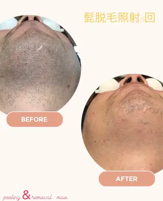 ピーリング＆脱毛 maoのエステ・リラクイメージ