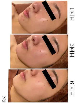 ニキビ特化型エステ 🍓最短で肌質改善のエステ・リラクイメージ