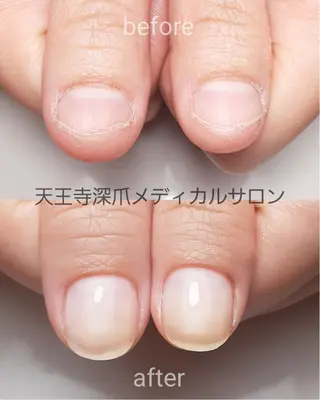 ネイル 天王寺 深爪メディカルサロンのネイルデザイン