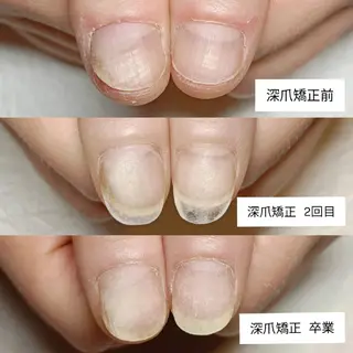 ネイル 深爪矯正/爪育成ケア manie nailのネイルデザイン