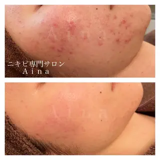 ミディアム パーマ ヘアアレンジ メンズ キッズ ネイル マツエク・マツパ ニキビ跡専門サロン Ａｉｎａのエステ・リラクイメージ