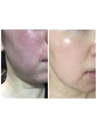 【リベルハーブピーリング認定店】敏感肌・美白脱毛専門店Dione立川店所属・Dione 立川店のエステ・リラクイメージ