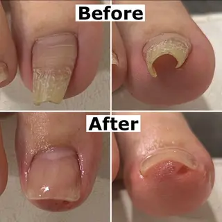 ネイル Mellow nail所属・巻爪無料モデル募集 ✨🦶MEGUMIのネイルデザイン