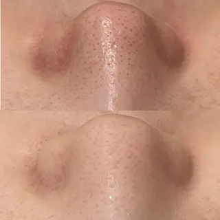 ニキビ特化型エステ 🍓最短で肌質改善のその他イメージ