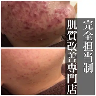 6万人の美肌実績🔥 最短ニキビ改善のエステ・リラクイメージ