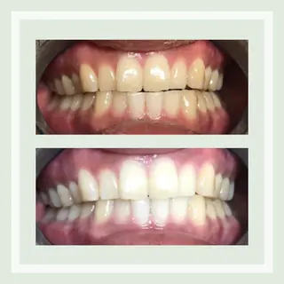 ホワイトニング｜韓国式3D毛穴洗浄 lonhana ﾛﾝﾊﾅ所属・韓国式3D毛穴洗浄 lonhanaのその他イメージ