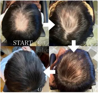 抜毛 薄毛 白髪 頭皮改善　柳沢慶のヘアスタイル