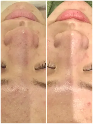 【リベルハーブピーリング認定店】敏感肌・美白脱毛専門店Dione立川店所属・Dione 立川店のエステ・リラクイメージ