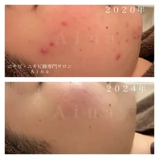ニキビ跡専門サロン Ａｉｎａのエステ・リラクイメージ