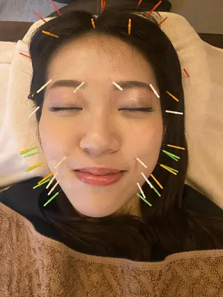Acupuncture  salon LINOA リノア鍼灸院所属・ヘッドスパ鍼/小顔鍼 耳ツボ 　LINOAのエステ・リラクイメージ