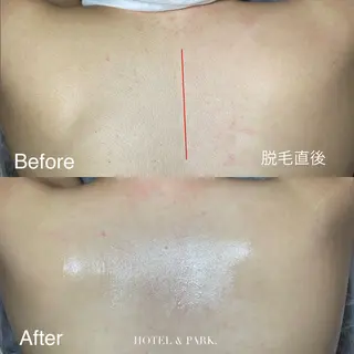 HOTEL&PARK . ワックス脱毛のエステ・リラクイメージ