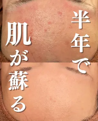 学生ニキビ改善🍀 優しい肌質改善のエステ・リラクイメージ