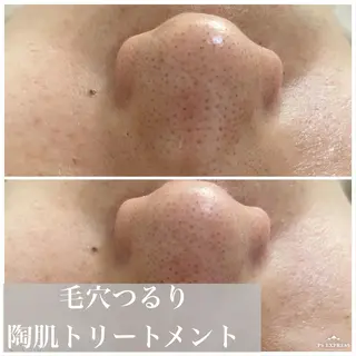 ニキビ・毛穴改善 🌿ハーブピーリングのエステ・リラクイメージ