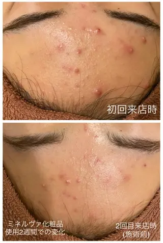 夏までに肌荒れ卒業 するサロン🌻のエステ・リラクイメージ