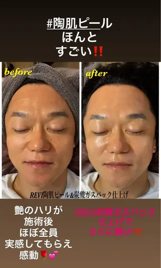 ハーブピーリング/韓国肌管理/フェイシャル/毛穴洗浄/眉毛/顔脱毛【糸脱毛専門】rev所属・ハーブピーリング🌹 毛穴洗浄❤️眉waxのエステ・リラクイメージ