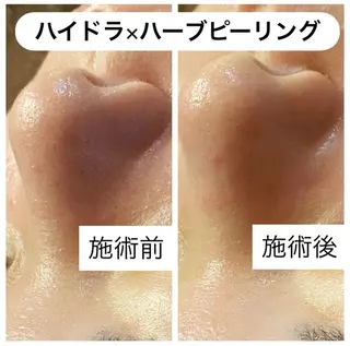 肌質改善専門 ハーブ /毛穴洗浄 リエイトのエステ・リラクイメージ