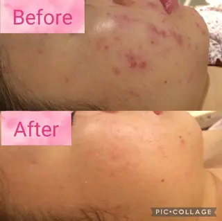 ニキビ跡改善専門🔥 医療にはできない改善のエステ・リラクイメージ