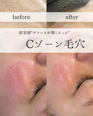 yc.hacci 【ハーブピーリング】のエステ・リラクイメージ