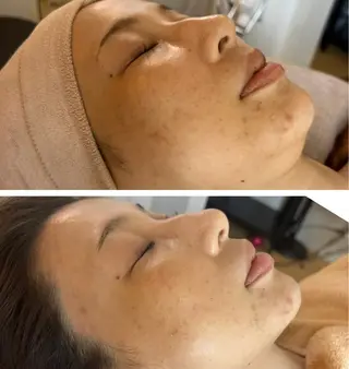 MiEL  total beaty salon所属・肌質改善サロン ナツコのエステ・リラクイメージ