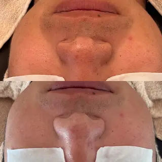 メンズ 毛穴ケア/毛穴診断/ 毛穴洗浄〔心斎橋〕のエステ・リラクイメージ