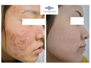 肌質改善専門サロン ／FSS渋谷店　松本のエステ・リラクイメージ