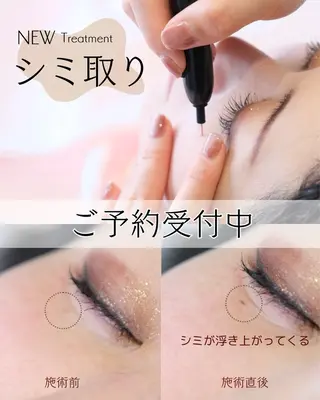 脱毛 シエスタ 山下 上級脱毛士のエステ・リラクイメージ