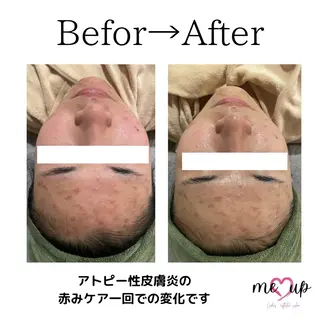 Meupニキビ専門店 背中/ハーブ/肌管理のその他イメージ
