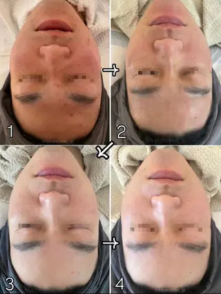 肌質改善 KALANCHOEのエステ・リラクイメージ