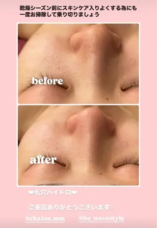 Chalon所属・REVI取扱・肌悩み 毛穴Chalonのエステ・リラクイメージ