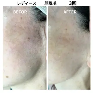 脱毛＆フェイシャル/ Rappore;増田のエステ・リラクイメージ