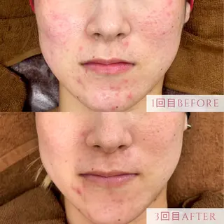 肌質改善/小顔/ ナスサロ/Yuiのエステ・リラクイメージ