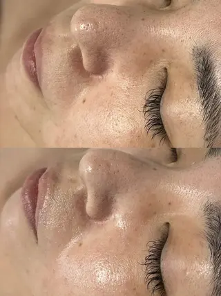 ニキビ／毛穴ケア ハーブピーリングのエステ・リラクイメージ