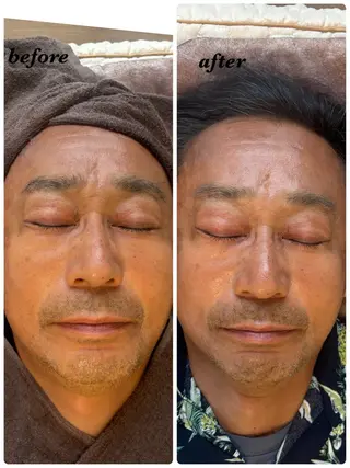 ハーブピーリング/韓国肌管理/フェイシャル/毛穴洗浄/眉毛/顔脱毛【糸脱毛専門】rev所属・ハーブピーリング🌹 毛穴洗浄❤️眉waxのエステ・リラクイメージ