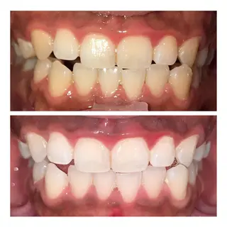 ホワイトニング｜韓国式3D毛穴洗浄 lonhana ﾛﾝﾊﾅ所属・韓国式3D毛穴洗浄 lonhanaのその他イメージ