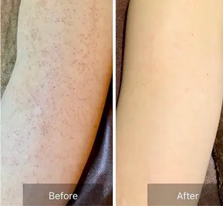 エミルカ　自由が丘店所属・ニキビ改善ハーブ🌿 ハナシマのその他イメージ