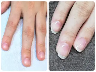 ネイル 深爪矯正/爪育成ケア manie nailのネイルデザイン