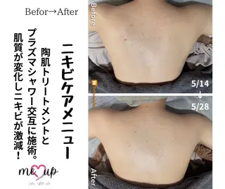 Meupニキビ専門店 背中/ハーブ/肌管理のその他イメージ