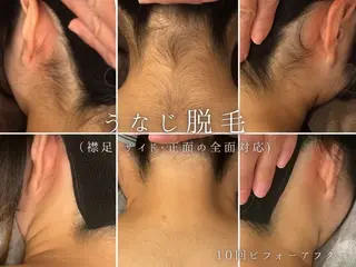 Beauty  salon Lino所属・🎀うなじ脱毛🎀 ㅣLino堀江のエステ・リラクイメージ